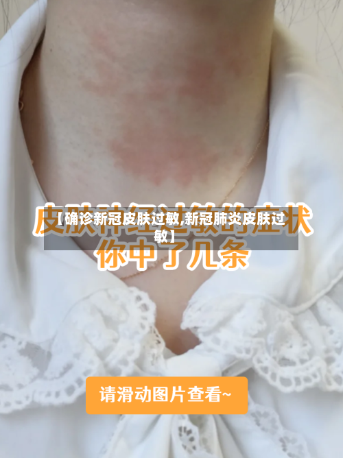 【确诊新冠皮肤过敏,新冠肺炎皮肤过敏】