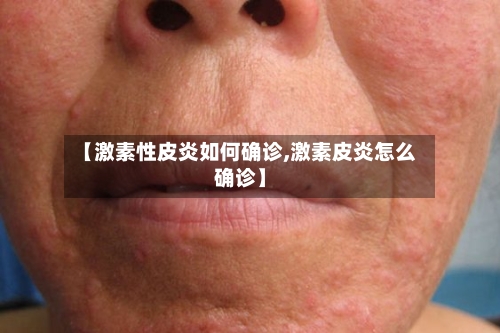 【激素性皮炎如何确诊,激素皮炎怎么确诊】