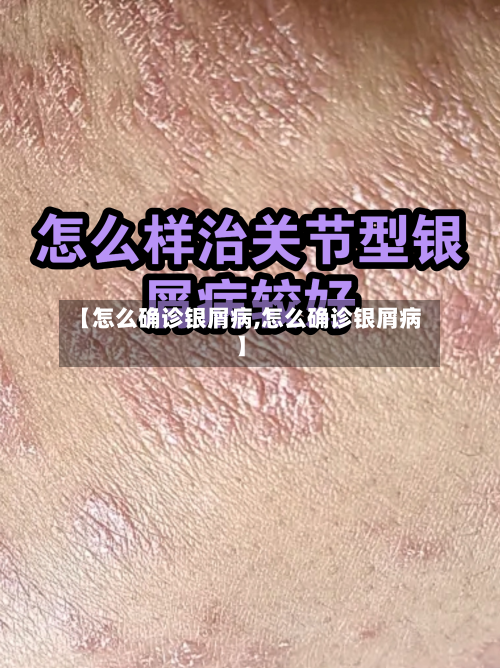【怎么确诊银屑病,怎么确诊银屑病】-第1张图片
