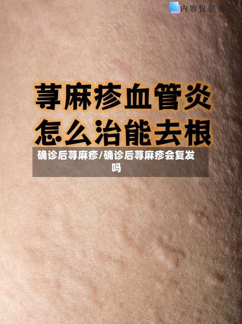确诊后荨麻疹/确诊后荨麻疹会复发吗-第1张图片