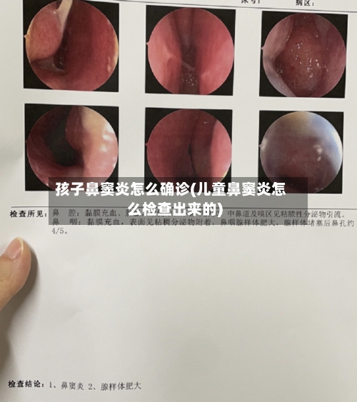孩子鼻窦炎怎么确诊(儿童鼻窦炎怎么检查出来的)-第2张图片