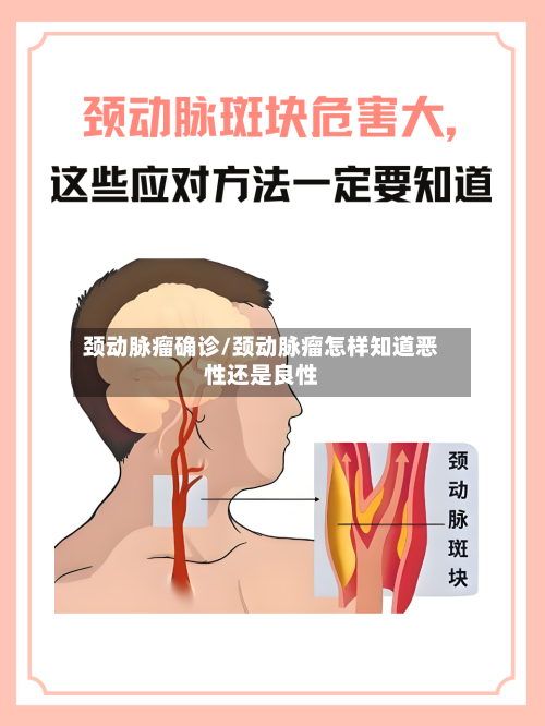 颈动脉瘤确诊/颈动脉瘤怎样知道恶性还是良性-第2张图片