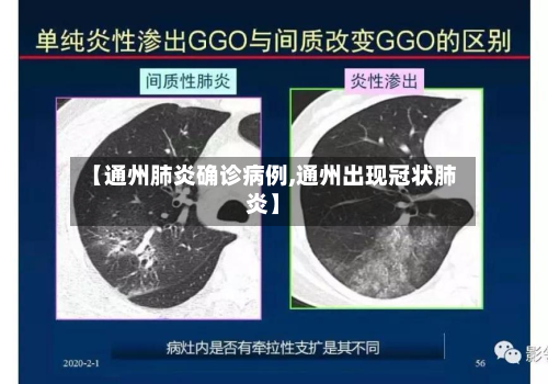 【通州肺炎确诊病例,通州出现冠状肺炎】