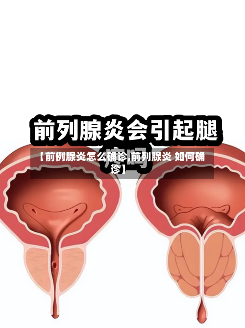 【前例腺炎怎么确诊,前列腺炎 如何确诊】-第2张图片