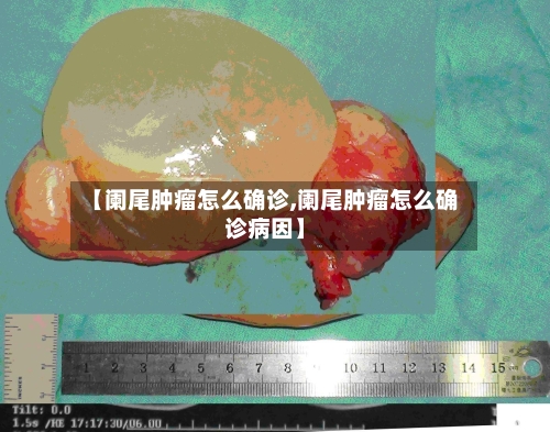 【阑尾肿瘤怎么确诊,阑尾肿瘤怎么确诊病因】-第2张图片