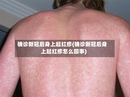 确诊新冠后身上起红疹(确诊新冠后身上起红疹怎么回事)
